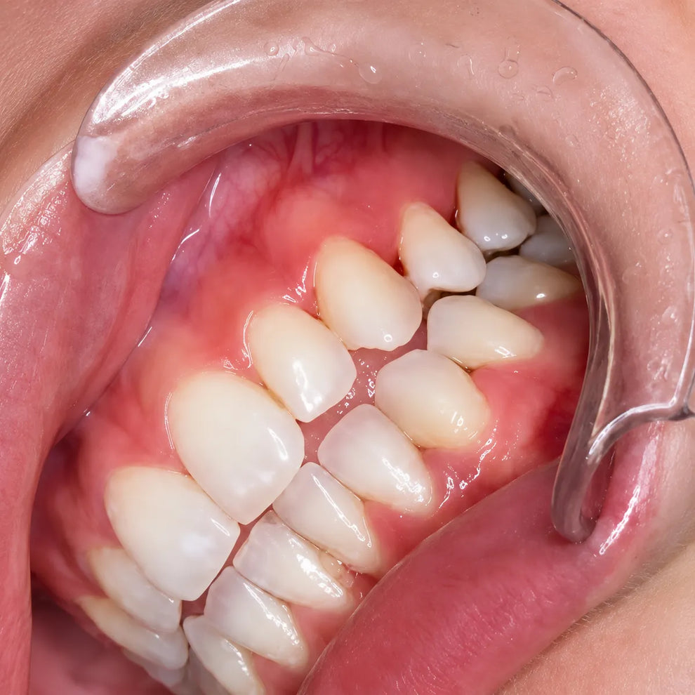 Close-up buccal view of teeth taken with a retractor.