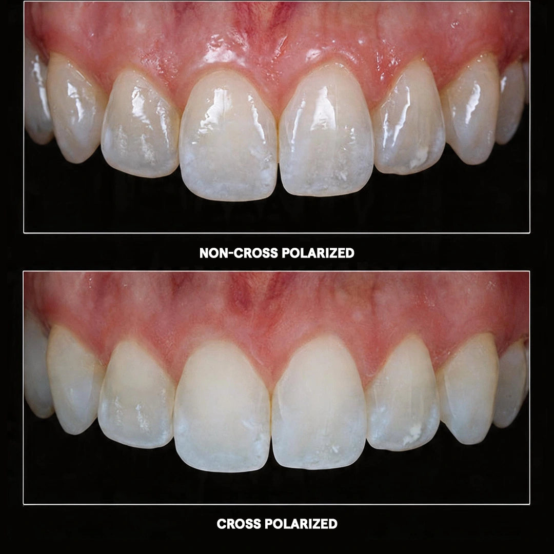 Cross polarized vs non-polarized intraoral dental photo comparison.