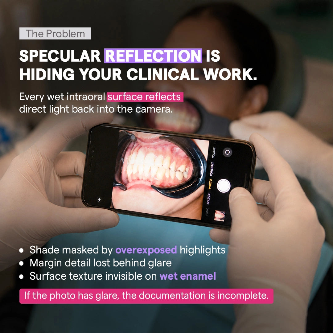 Intraoral photo with glare and reflection from phone flash.