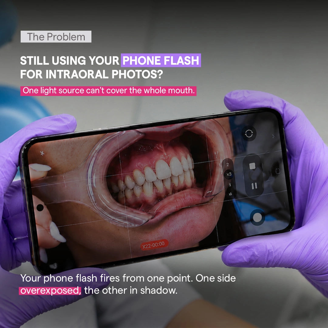 Smartphone showing an intraoral photo taken with phone flash.