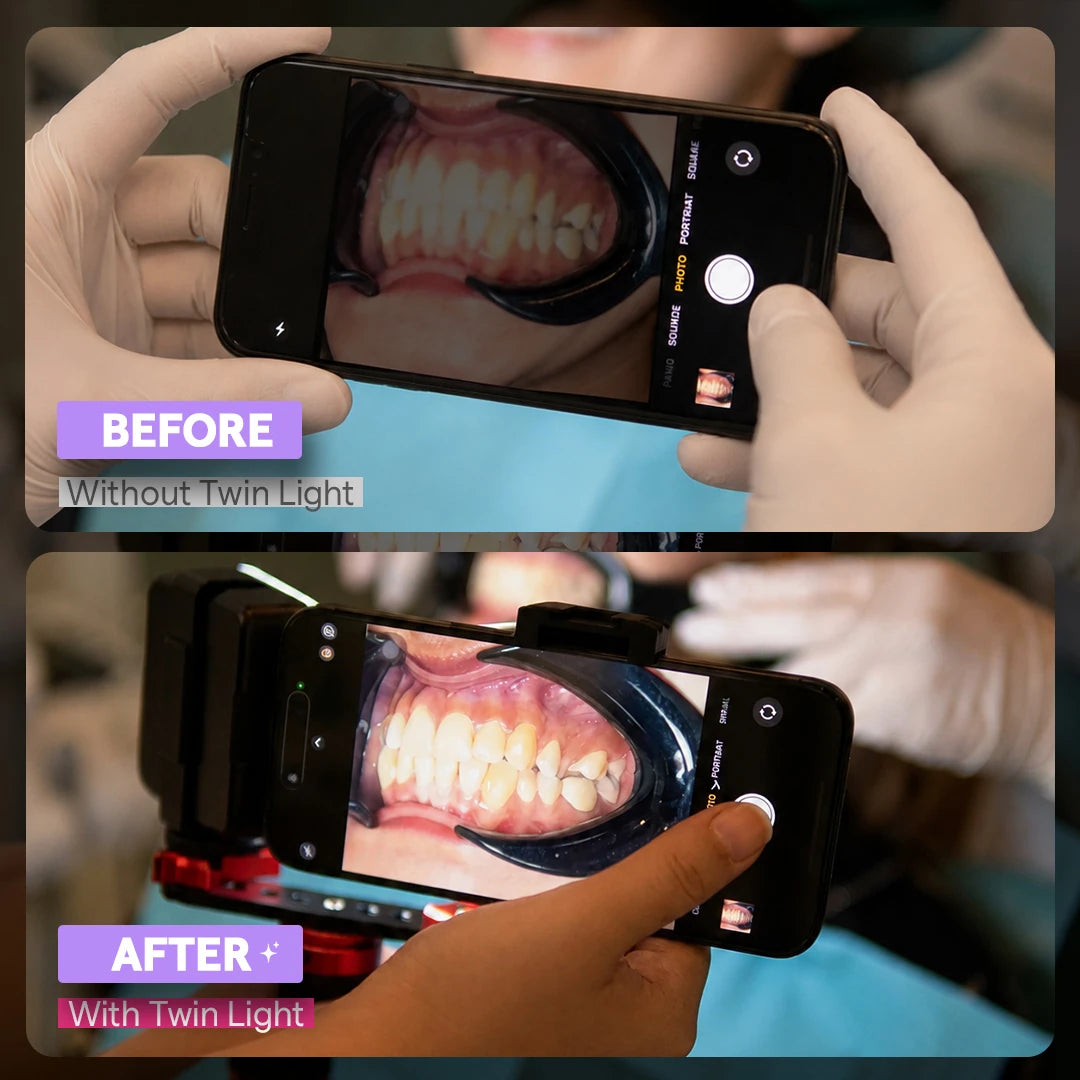 Twin Light vs phone flash for dental photography